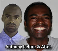 Anthny Before&After